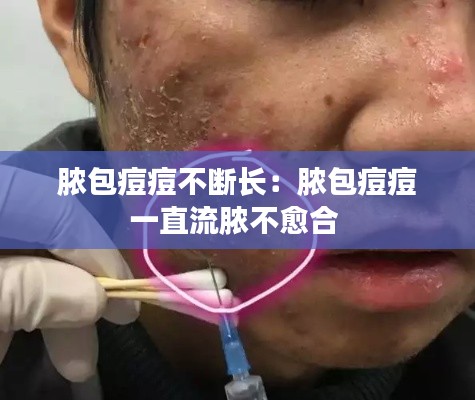 脓包痘痘不断长：脓包痘痘一直流脓不愈合 