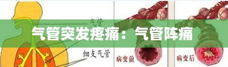 气管突发疼痛：气管阵痛 